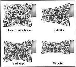 Wirbelkörper