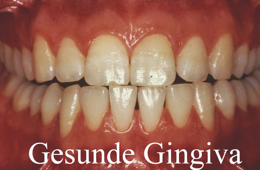 Gesunde Gingiva