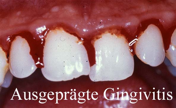 Ausgeprägte Gingivitis mit starker Blutungsneigung